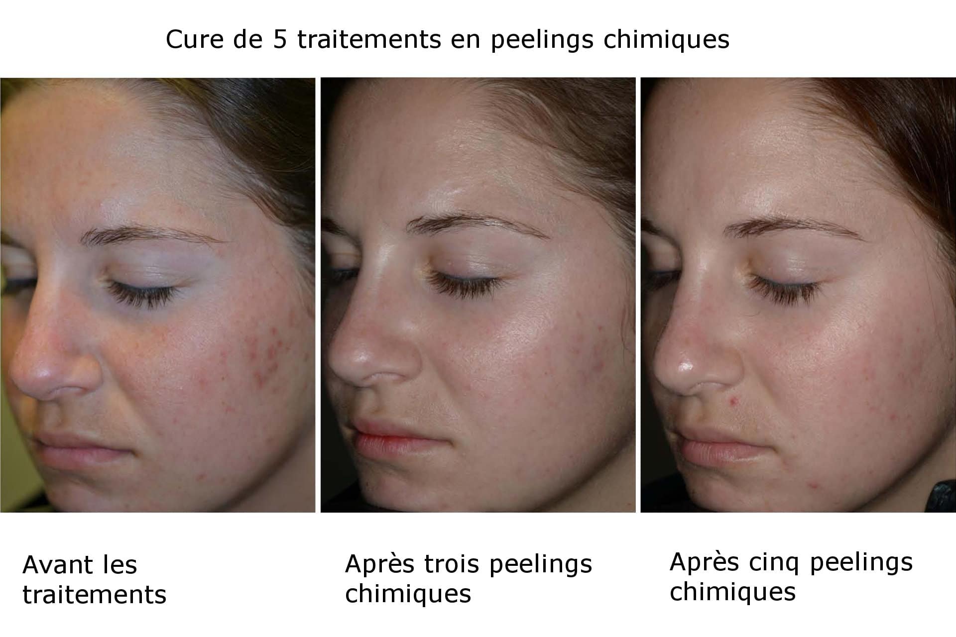Peach Peel для лица до после